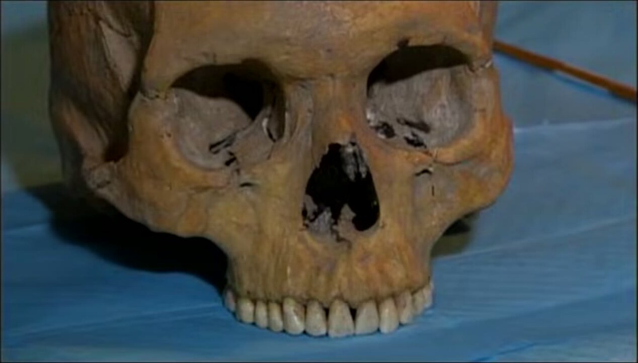 Un cráneo chanka trepanado